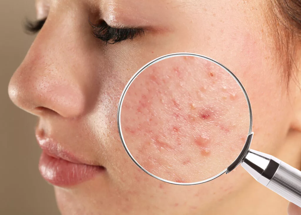 a girl suffering from fungal acne