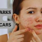 acne marks vs. acne scars