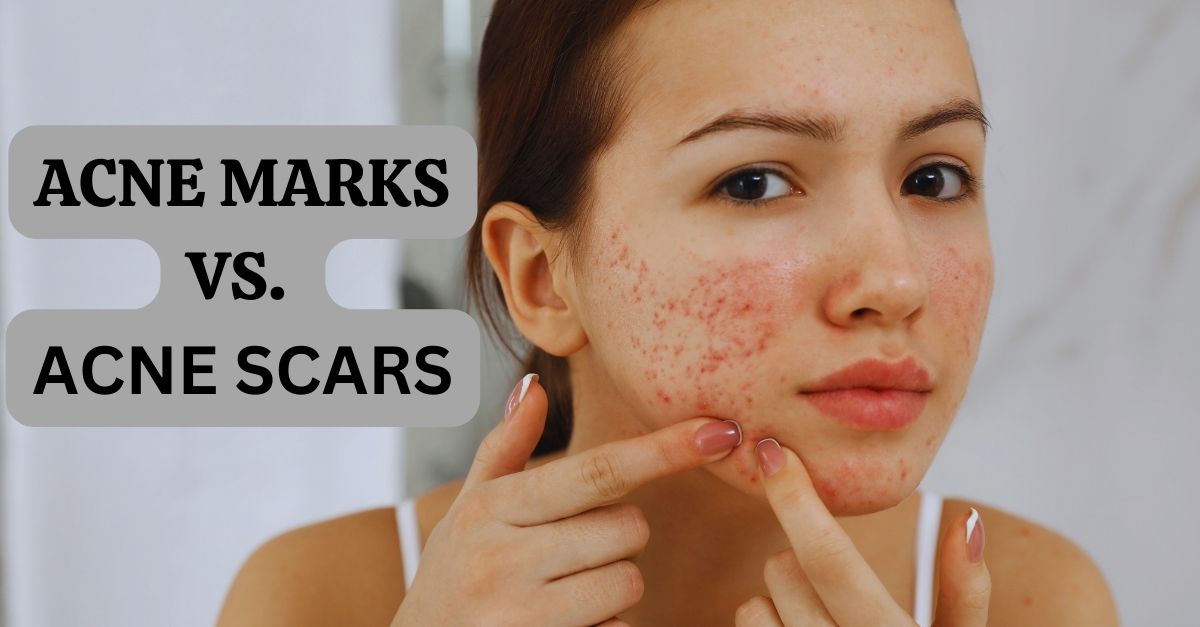 acne marks vs. acne scars