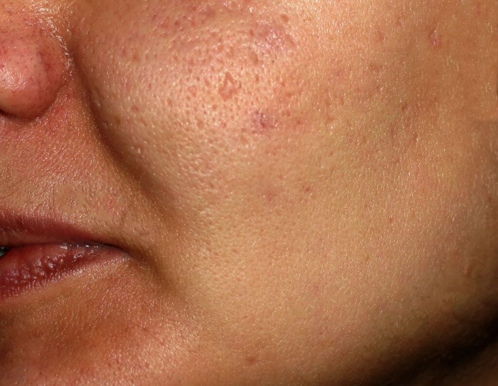 Ice pick atrophic acne scars