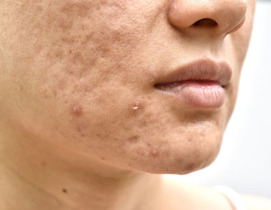 rolling atrophic acne scars